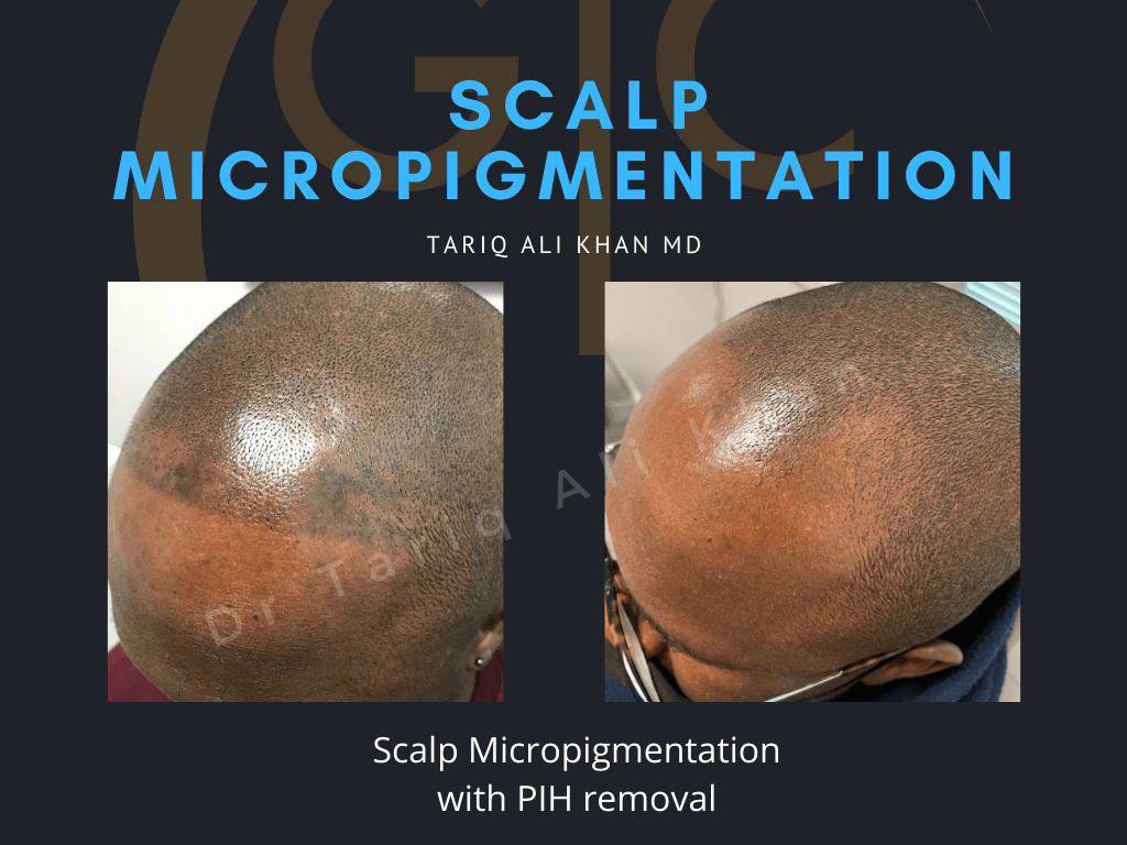 Gentle Care Laser Tustin Before and After picture - Scalp micropigmentation